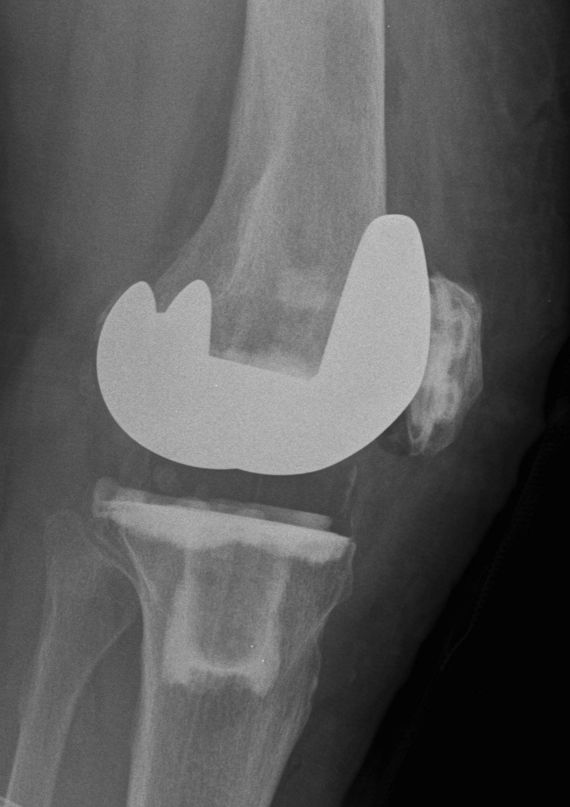 TKR All Poly Tibia Lateral